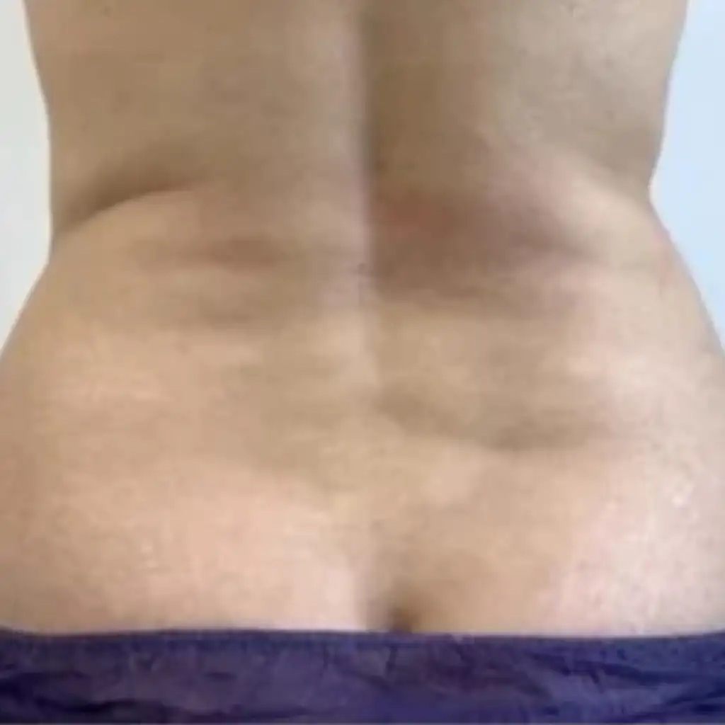 VASER Liposuction Before