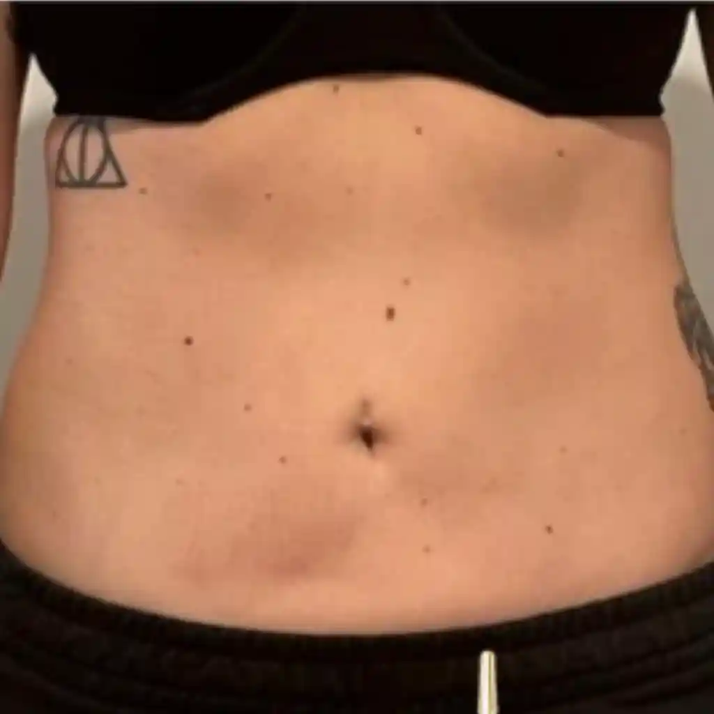 Stomach Fat Removal After 2