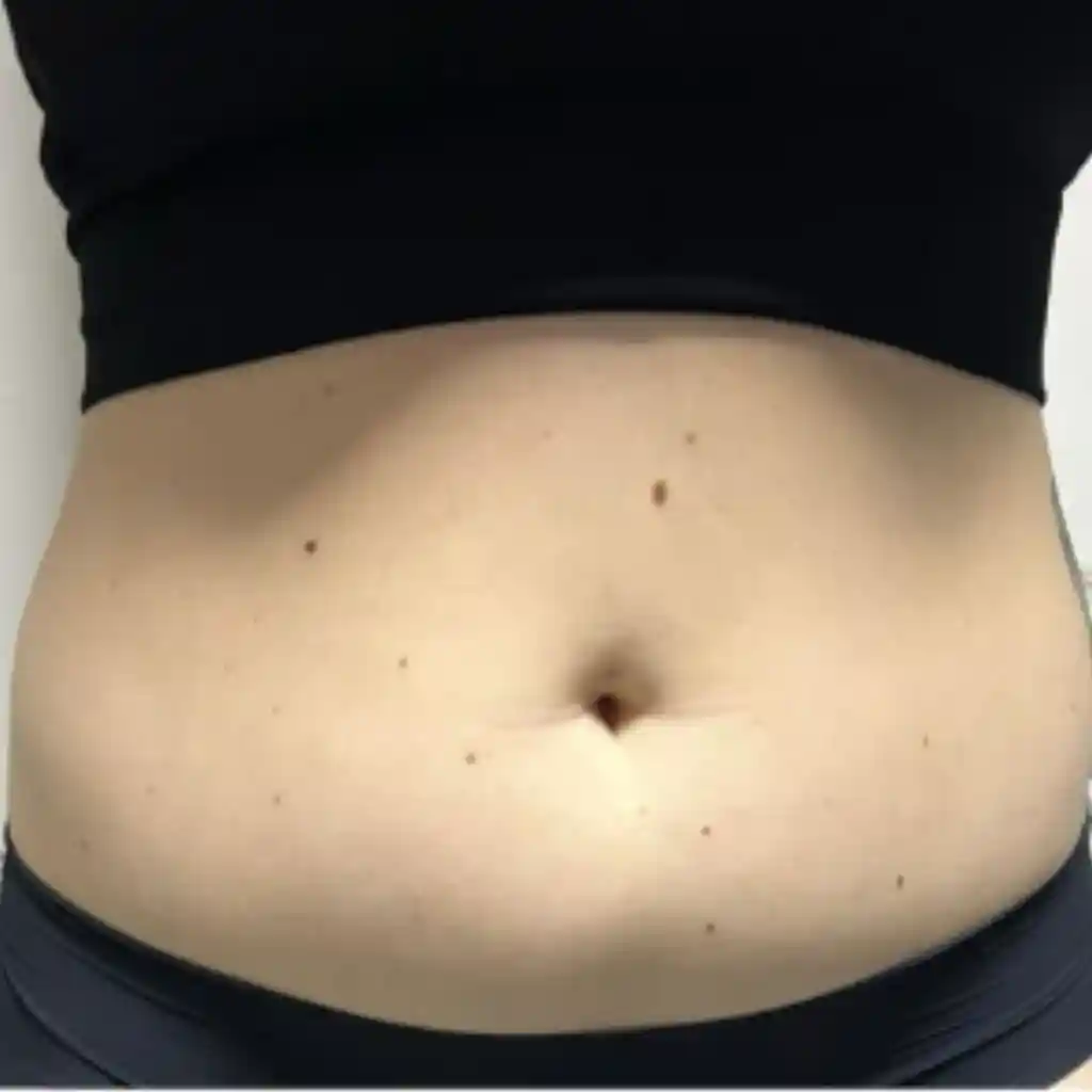 Stomach Fat Removal Before 2