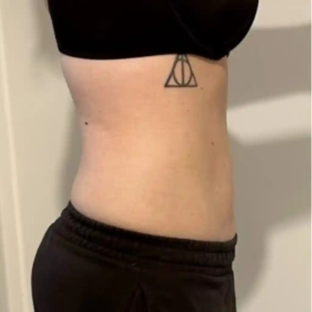 Stomach Fat Removal After 3