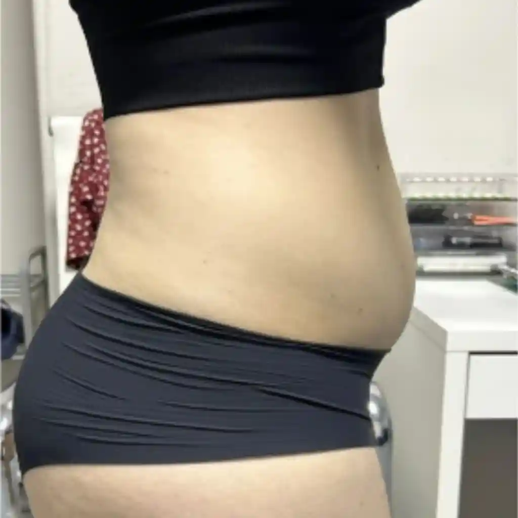 Stomach Fat Removal Before 3