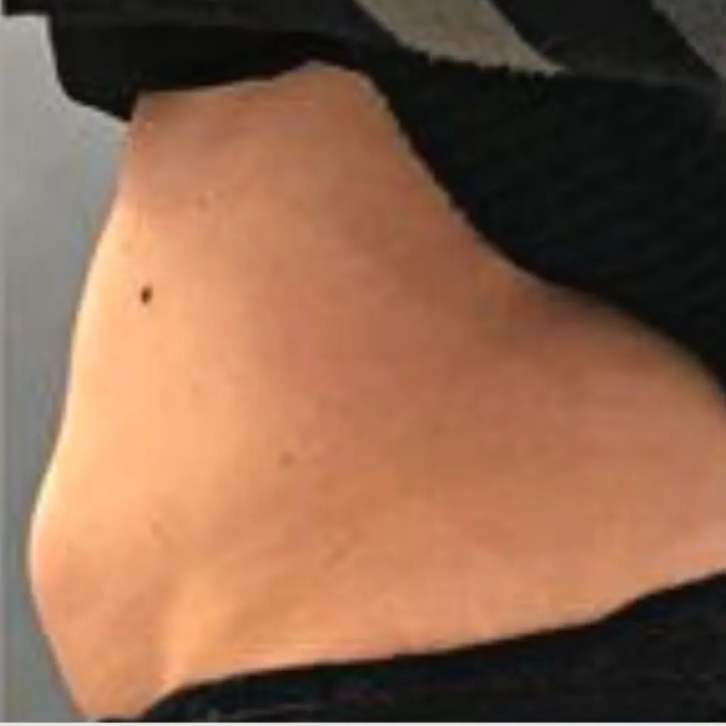 Stomach Fat Removal Before