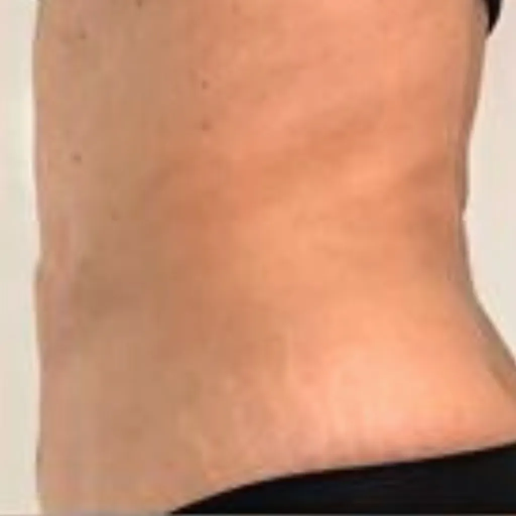 Stomach Fat Removal After