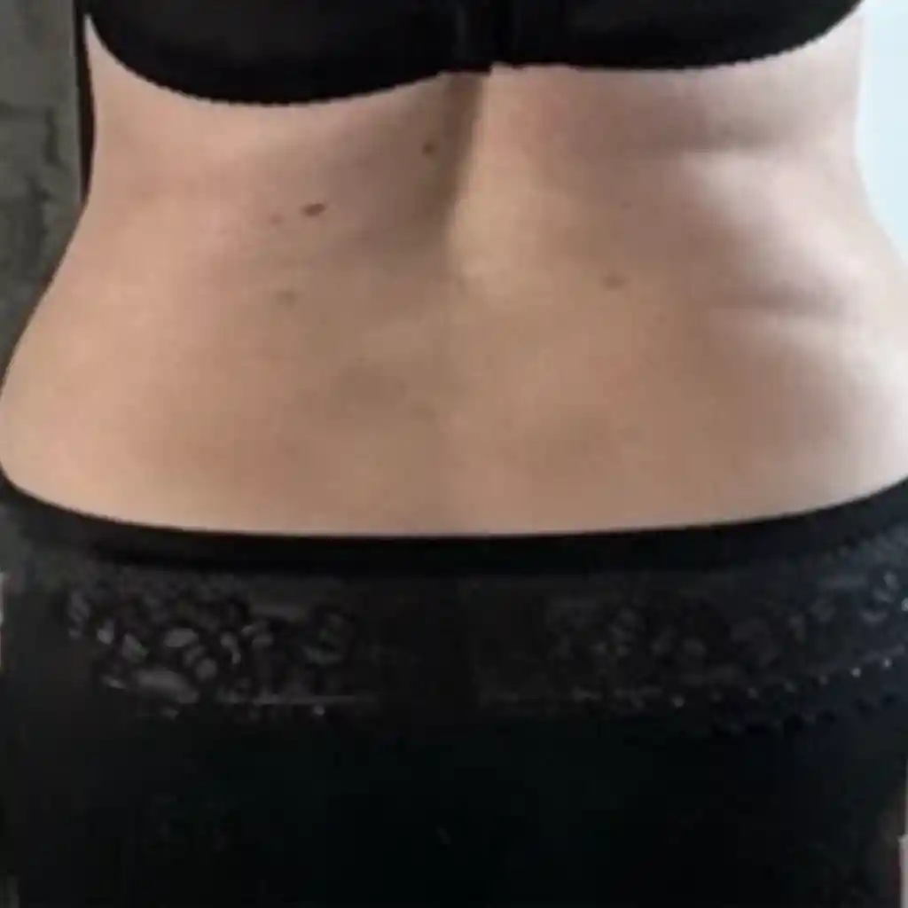 360° Liposuction After