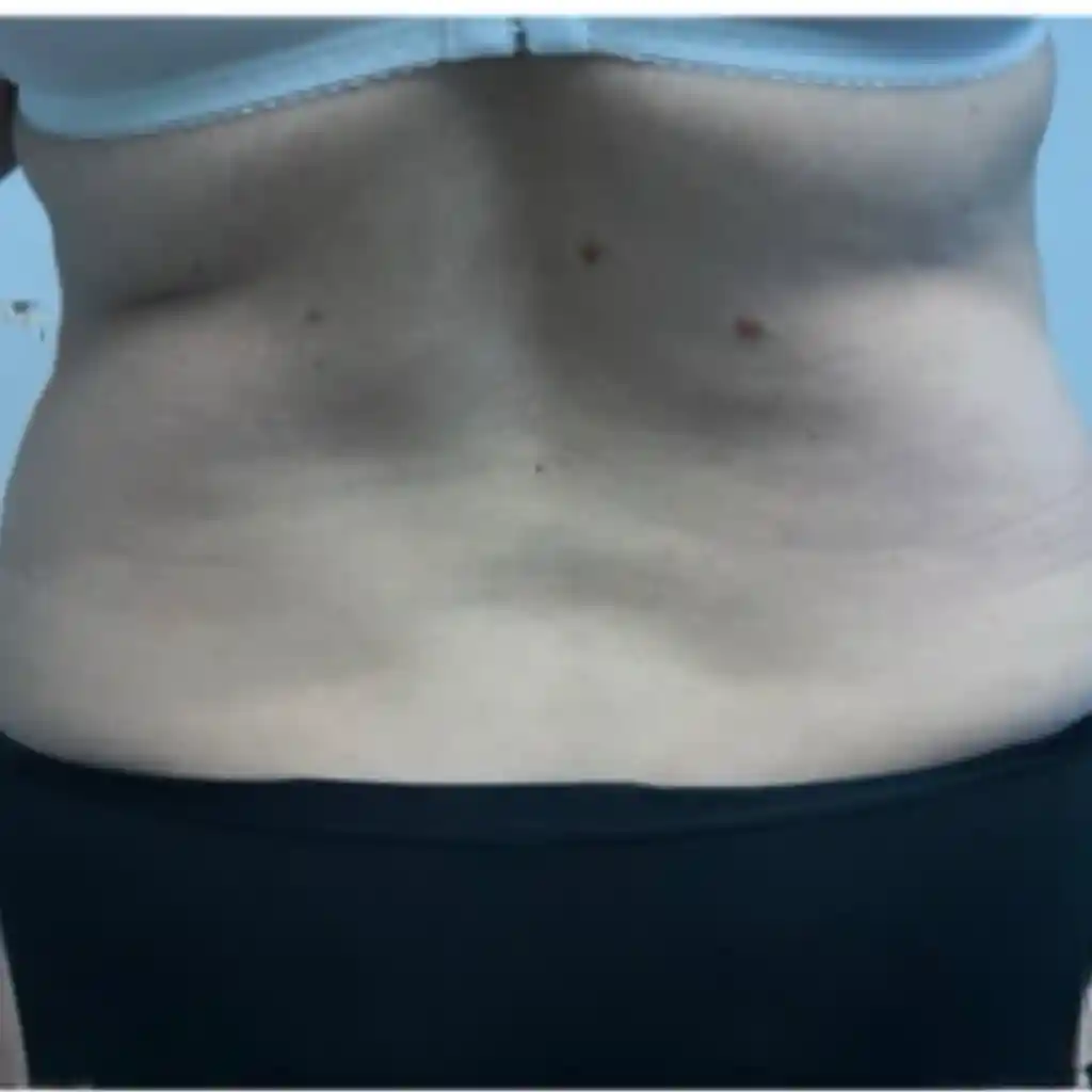 360° Liposuction Before 2