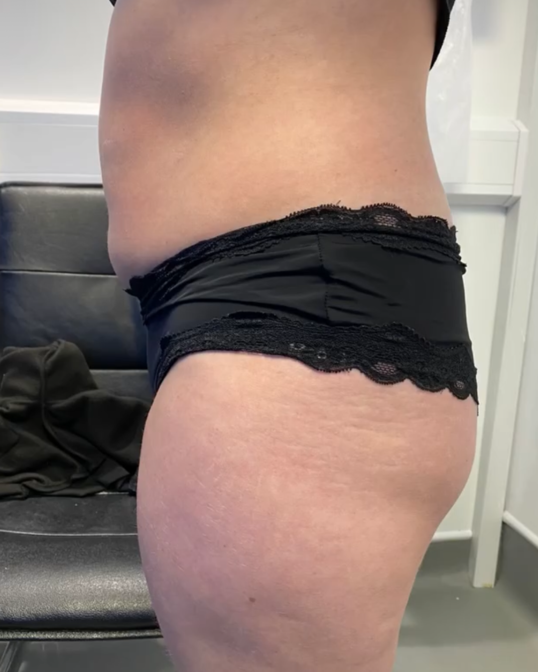 Liposuction Results – Before