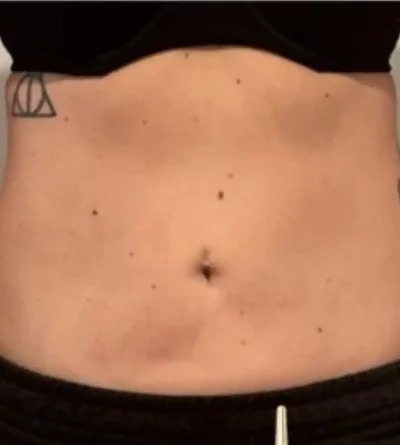 VASER Liposuction After 5