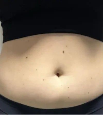 VASER Liposuction Before 5