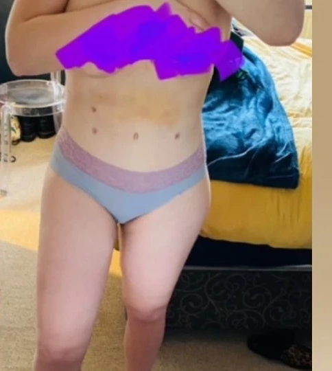 VASER Liposuction After