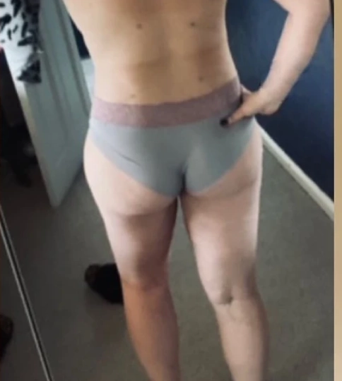 VASER Liposuction after 3