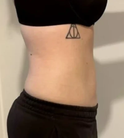 VASER Liposuction After 4